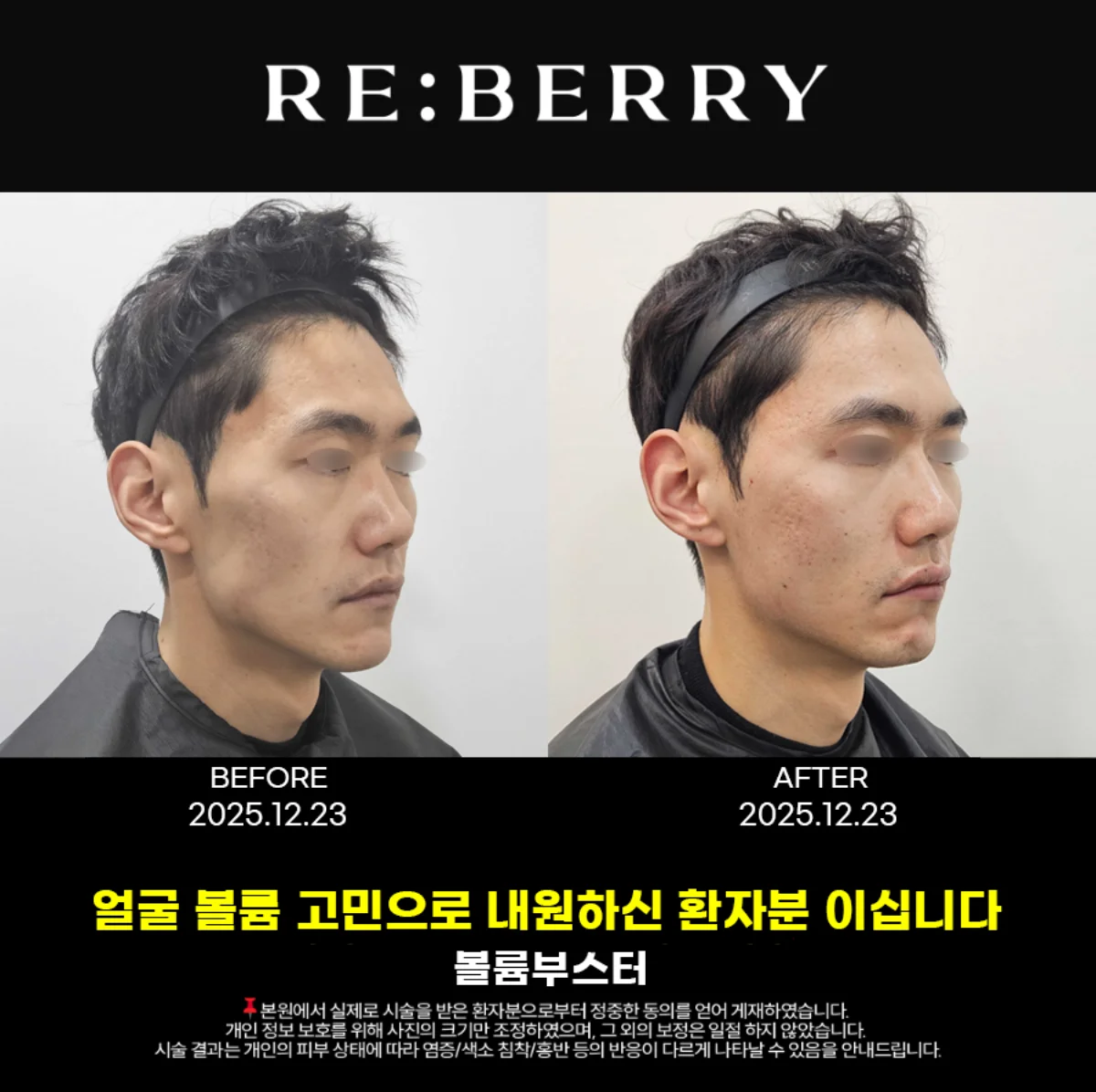 Botox jawline slimming before and after result at RE:BERRY Myeongdong